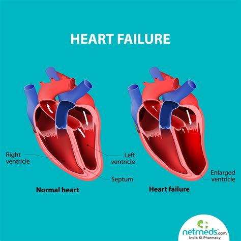 lv medical abbreviation cardiology|what is severe lv dysfunction.